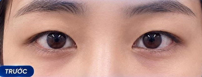 Trước cắt mí
